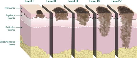 clark level 3 melanoma